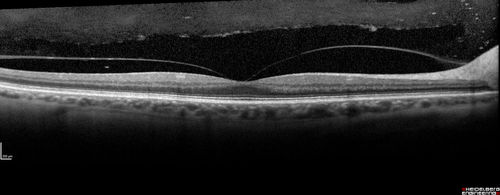 Neuroretinitis and Multifocal Retinitis
62 year old female with vision loss in the left eye to 20/160. Positive Bartonellas IgG.  Vision recovered in 2 months.  She was treated with Oral Erythromycin BID for 2 weeks.
