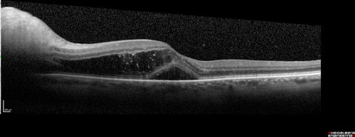 Neuroretinitis and Multifocal Retinitis
62 year old female with vision loss in the left eye to 20/160. Positive Bartonellas IgG.  Vision recovered in 2 months.  She was treated with Oral Erythromycin BID for 2 weeks.
