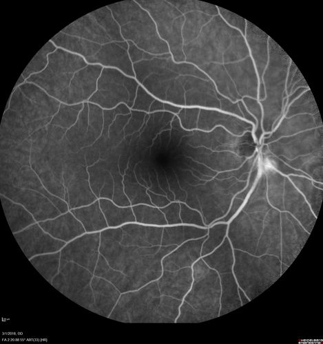 Neuroretinitis and Multifocal Retinitis
62 year old female with vision loss in the left eye to 20/160. Positive Bartonellas IgG.  Vision recovered in 2 months.  She was treated with Oral Erythromycin BID for 2 weeks.
