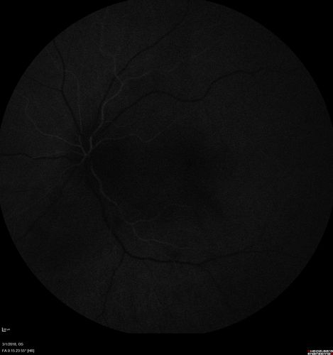 Neuroretinitis and Multifocal Retinitis
62 year old female with vision loss in the left eye to 20/160. Positive Bartonellas IgG.  Vision recovered in 2 months.  She was treated with Oral Erythromycin BID for 2 weeks.
