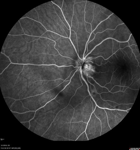 Neuroretinitis and Multifocal Retinitis
62 year old female with vision loss in the left eye to 20/160. Positive Bartonellas IgG.  Vision recovered in 2 months.  She was treated with Oral Erythromycin BID for 2 weeks.
