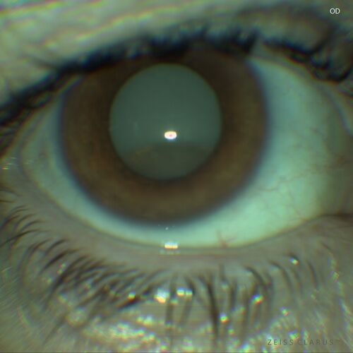Cataract Morgagnian

