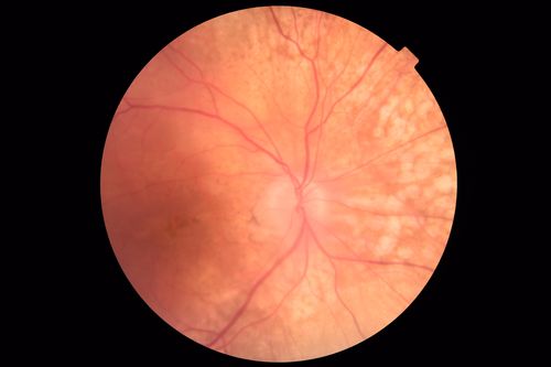 Choroidal Thickening
78 year old man followed for 4 months with choroidal thickening.  Cursory systemic evaluation with no imaging shows no cancer.  Vision is stable or improving.
