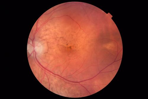 Choroidal Thickening
78 year old man followed for 4 months with choroidal thickening.  Cursory systemic evaluation with no imaging shows no cancer.  Vision is stable or improving.
