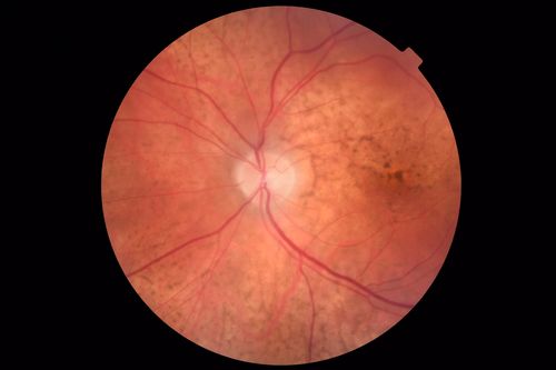 Choroidal Thickening
78 year old man followed for 4 months with choroidal thickening.  Cursory systemic evaluation with no imaging shows no cancer.  Vision is stable or improving.
