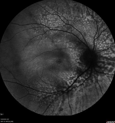 Choroidal Thickening
78 year old man followed for 4 months with choroidal thickening.  Cursory systemic evaluation with no imaging shows no cancer.  Vision is stable or improving.
