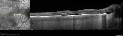 Choroidal Thickening
78 year old man followed for 4 months with choroidal thickening.  Cursory systemic evaluation with no imaging shows no cancer.  Vision is stable or improving.
