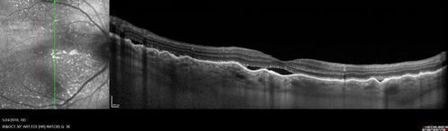 Choroidal Thickening
78 year old man followed for 4 months with choroidal thickening.  Cursory systemic evaluation with no imaging shows no cancer.  Vision is stable or improving.
