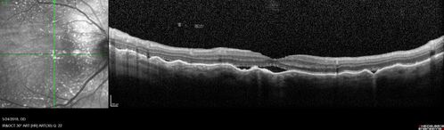Choroidal Thickening
78 year old man followed for 4 months with choroidal thickening.  Cursory systemic evaluation with no imaging shows no cancer.  Vision is stable or improving.
