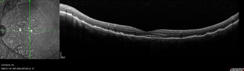 Choroidal Thickening
78 year old man followed for 4 months with choroidal thickening.  Cursory systemic evaluation with no imaging shows no cancer.  Vision is stable or improving.
