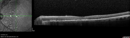 Choroidal Thickening
78 year old man followed for 4 months with choroidal thickening.  Cursory systemic evaluation with no imaging shows no cancer.  Vision is stable or improving.
