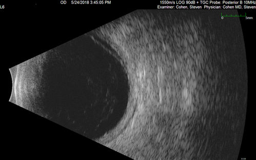 Choroidal Thickening
78 year old man followed for 4 months with choroidal thickening.  Cursory systemic evaluation with no imaging shows no cancer.  Vision is stable or improving.
