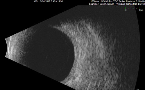 Choroidal Thickening
78 year old man followed for 4 months with choroidal thickening.  Cursory systemic evaluation with no imaging shows no cancer.  Vision is stable or improving.
