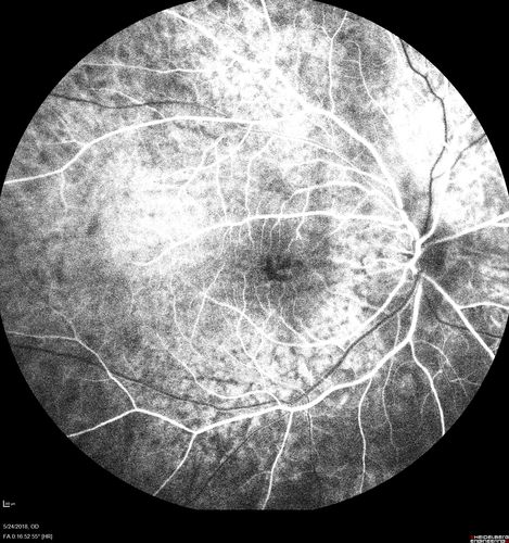 Choroidal Thickening
78 year old man followed for 4 months with choroidal thickening.  Cursory systemic evaluation with no imaging shows no cancer.  Vision is stable or improving.
