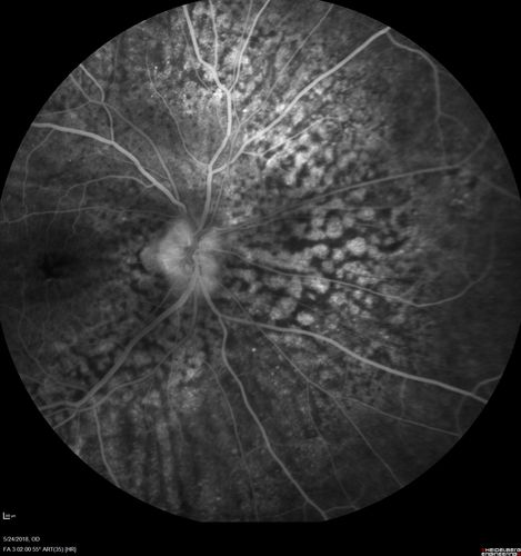 Choroidal Thickening
78 year old man followed for 4 months with choroidal thickening.  Cursory systemic evaluation with no imaging shows no cancer.  Vision is stable or improving.
