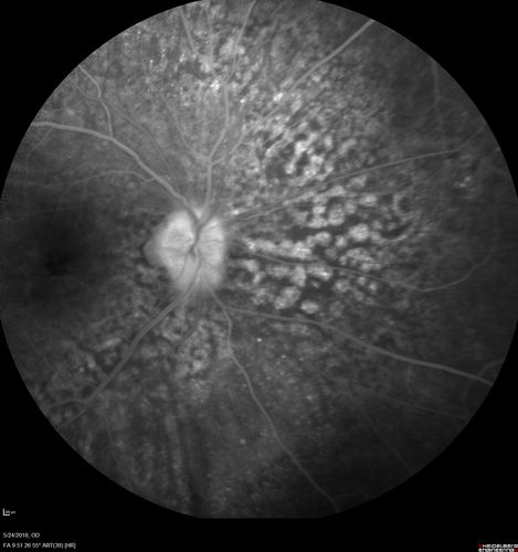 Choroidal Thickening
78 year old man followed for 4 months with choroidal thickening.  Cursory systemic evaluation with no imaging shows no cancer.  Vision is stable or improving.
