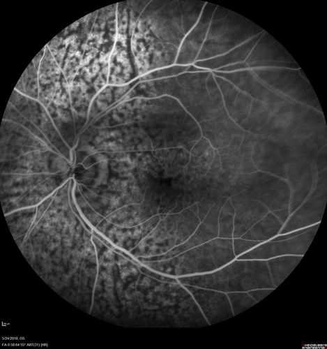 Choroidal Thickening
78 year old man followed for 4 months with choroidal thickening.  Cursory systemic evaluation with no imaging shows no cancer.  Vision is stable or improving.
