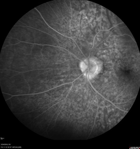 Choroidal Thickening
78 year old man followed for 4 months with choroidal thickening.  Cursory systemic evaluation with no imaging shows no cancer.  Vision is stable or improving.
