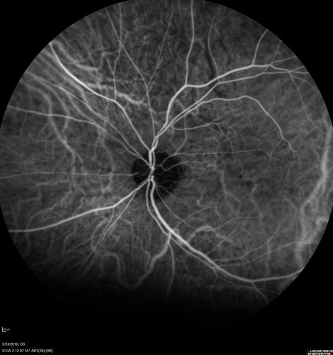 Choroidal Thickening
78 year old man followed for 4 months with choroidal thickening.  Cursory systemic evaluation with no imaging shows no cancer.  Vision is stable or improving.
