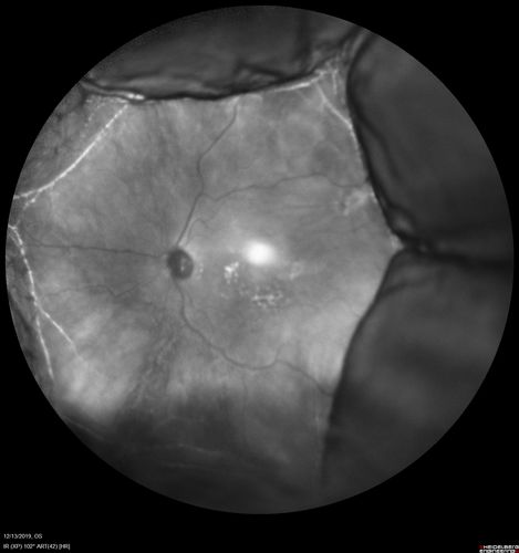 Choroidal Effusions following Glaucoma Surgery 9 months ago
67 year old female with glaucoma surgery 9 month ago.  Her IOP is 12.  She has peripheral choroidal effusions.  VA 20/100 ph 20/32
