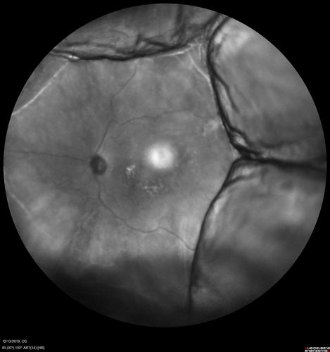 Choroidal Effusions following Glaucoma Surgery 9 months ago
67 year old female with glaucoma surgery 9 month ago.  Her IOP is 12.  She has peripheral choroidal effusions.  VA 20/100 ph 20/32
