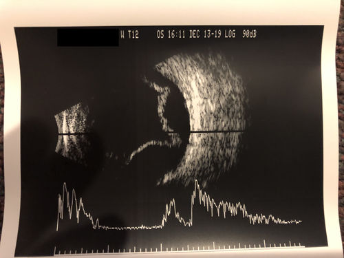 Choroidal Effusions following Glaucoma Surgery 9 months ago
67 year old female with glaucoma surgery 9 month ago.  Her IOP is 12.  She has peripheral choroidal effusions.  VA 20/100 ph 20/32
