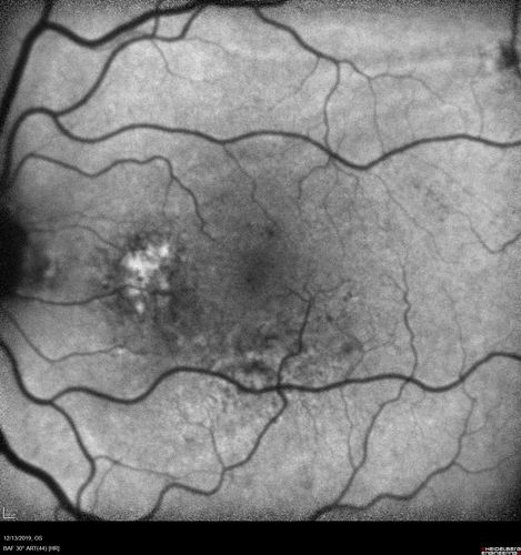 Choroidal Effusions following Glaucoma Surgery 9 months ago
67 year old female with glaucoma surgery 9 month ago.  Her IOP is 12.  She has peripheral choroidal effusions.  VA 20/100 ph 20/32
