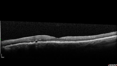 Choroidal Effusions following Glaucoma Surgery 9 months ago
67 year old female with glaucoma surgery 9 month ago.  Her IOP is 12.  She has peripheral choroidal effusions.  VA 20/100 ph 20/32
