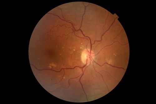 Chronic Endophthalmitis and Cystoid Macular Edema
VA 20/50 - Culture negative. Cleared with intravitreal antibiotics and decadron
