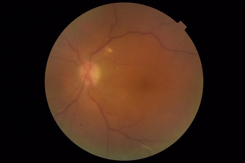 Chronic Endophthalmitis and Cystoid Macular Edema
VA 20/50 - Culture negative. Cleared with intravitreal antibiotics and decadron
