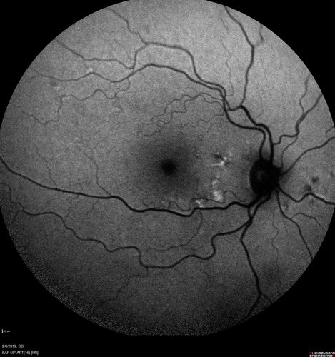 Chronic Endophthalmitis and Cystoid Macular Edema
VA 20/50 - Culture negative. Cleared with intravitreal antibiotics and decadron
