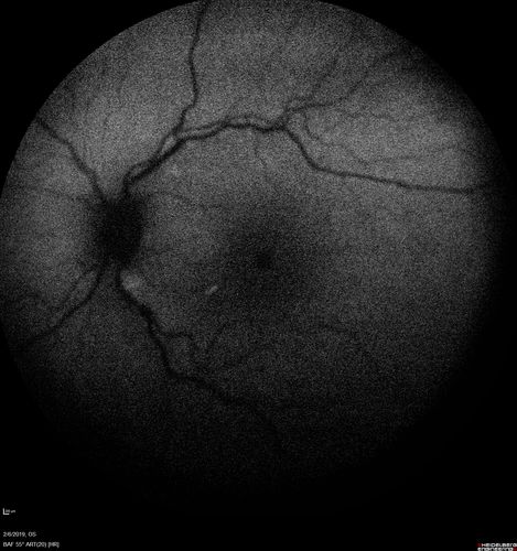 Chronic Endophthalmitis and Cystoid Macular Edema
VA 20/50 - Culture negative. Cleared with intravitreal antibiotics and decadron
