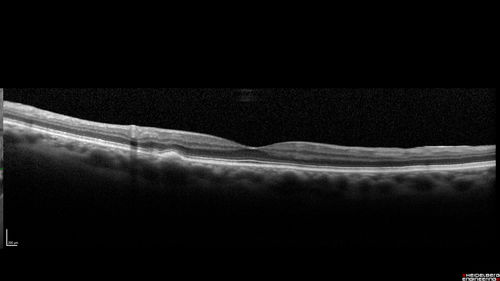 Chronic Endophthalmitis and Cystoid Macular Edema
VA 20/50 - Culture negative. Cleared with intravitreal antibiotics and decadron
