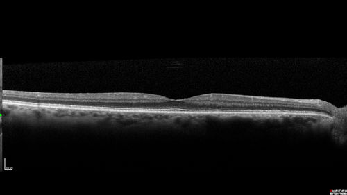 Chronic Endophthalmitis and Cystoid Macular Edema
VA 20/50 - Culture negative. Cleared with intravitreal antibiotics and decadron
