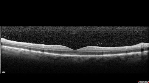 Chronic Endophthalmitis and Cystoid Macular Edema
VA 20/50 - Culture negative. Cleared with intravitreal antibiotics and decadron
