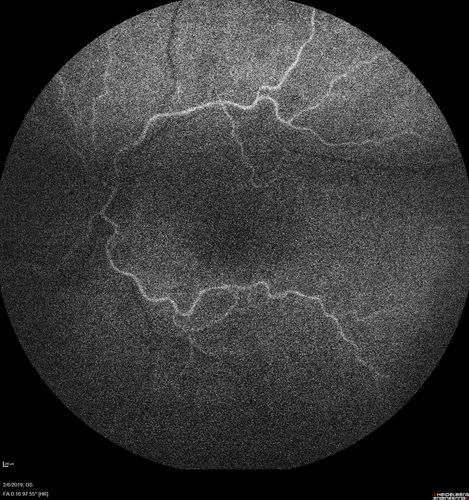Chronic Endophthalmitis and Cystoid Macular Edema
VA 20/50 - Culture negative. Cleared with intravitreal antibiotics and decadron
