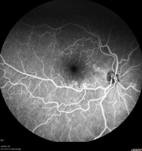 Chronic Endophthalmitis and Cystoid Macular Edema
VA 20/50 - Culture negative. Cleared with intravitreal antibiotics and decadron
