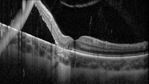Chronic macula-splitting demarcated retinal detachment
35 year old female with 20/25 vision and noticing something wrong with the superior vision in the right eye for a long time.
