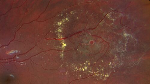 Coats' Disease - 8-year-old boy - Asymptomatic
Normal vision - Lesion picked up on examination
