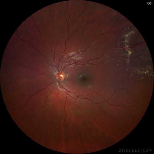 Coats' Disease - 8-year-old boy - Asymptomatic
Normal vision - Lesion picked up on examination
