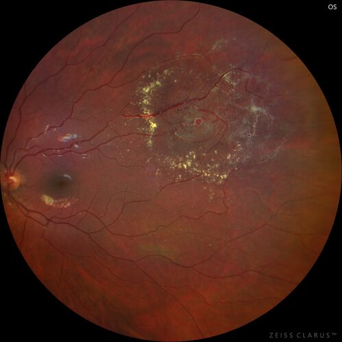 Coats' Disease - 8-year-old boy - Asymptomatic
Normal vision - Lesion picked up on examination
