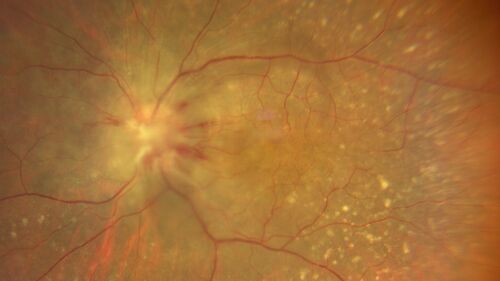 Ocular Lymphoma - Flare up despite chemotherapy and radiation therapy - This was treated with intravitreal methotrexate
Vision in the left eye has declined to LP in this image following ocular recurrence of lymphoma
