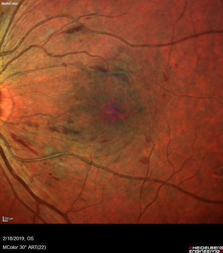 Diabetic Macular Edema - One eye treated with Eylea and 2 weeks later both were improved
68 year old female with diabetic retinopathy and macular edema   
VA OD: sc20/40 PH20/32
VA OS: sc20/40 PH20/32
IOP: TP: OD:14 OS:14 Time:12:45
