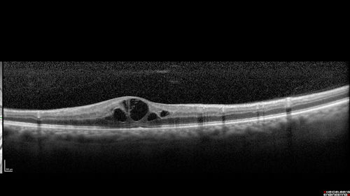 Diabetic Macular Edema - One eye treated with Eylea and 2 weeks later both were improved
68 year old female with diabetic retinopathy and macular edema   
VA OD: sc20/40 PH20/32
VA OS: sc20/40 PH20/32
IOP: TP: OD:14 OS:14 Time:12:45
