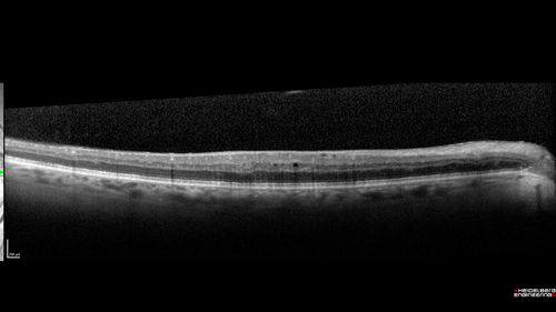 Diabetic Macular Edema - One eye treated with Eylea and 2 weeks later both were improved
68 year old female with diabetic retinopathy and macular edema   
VA OD: sc20/40 PH20/32
VA OS: sc20/40 PH20/32
IOP: TP: OD:14 OS:14 Time:12:45
