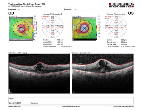 Diabetic Macular Edema - One eye treated with Eylea and 2 weeks later both were improved
68 year old female with diabetic retinopathy and macular edema   
VA OD: sc20/40 PH20/32
VA OS: sc20/40 PH20/32
IOP: TP: OD:14 OS:14 Time:12:45
