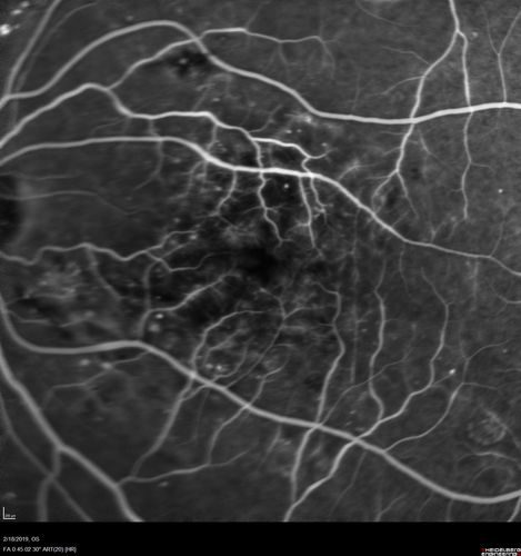 Diabetic Macular Edema - One eye treated with Eylea and 2 weeks later both were improved
68 year old female with diabetic retinopathy and macular edema   
VA OD: sc20/40 PH20/32
VA OS: sc20/40 PH20/32
IOP: TP: OD:14 OS:14 Time:12:45
