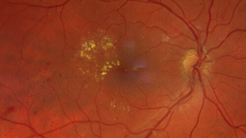 Macular ischemia left eye in type I diabetic (enlarged foveal avascular zone)
29 year old female with type I diabetes since age 5.  Left eye has enlarged FAZ with vision of 20/20 OD and 20/60 OS.  Both eyes have CSME.  The left eye did have focal laser
