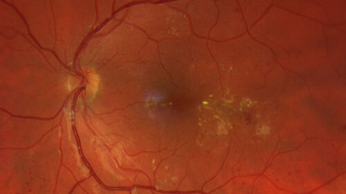Macular ischemia left eye in type I diabetic (enlarged foveal avascular zone)
29 year old female with type I diabetes since age 5.  Left eye has enlarged FAZ with vision of 20/20 OD and 20/60 OS.  Both eyes have CSME.  The left eye did have focal laser
