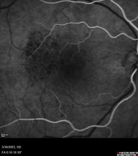 Macular ischemia left eye in type I diabetic (enlarged foveal avascular zone)
29 year old female with type I diabetes since age 5.  Left eye has enlarged FAZ with vision of 20/20 OD and 20/60 OS.  Both eyes have CSME.  The left eye did have focal laser
